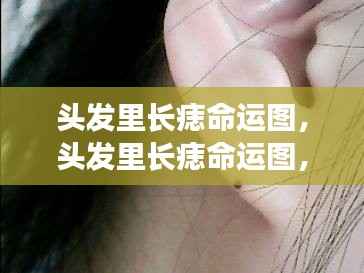 头发里长痣命运图解析,痣的位置预示未来运势走向