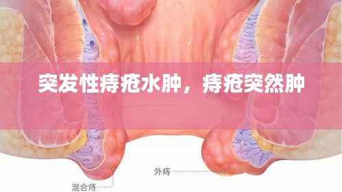 突发性痔疮水肿,痔疮突然肿